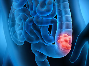 Colorectal Cancer