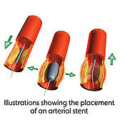 Heart Block: Illustration Showing Placement of Arterial Stent