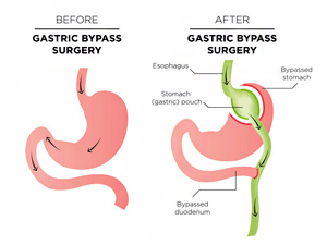 Image result for gastric bypass