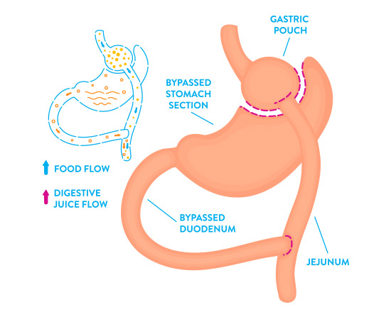 Gastric Bypass Surgery