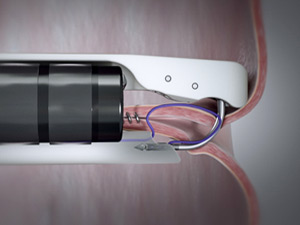 Endoscopic Suturing