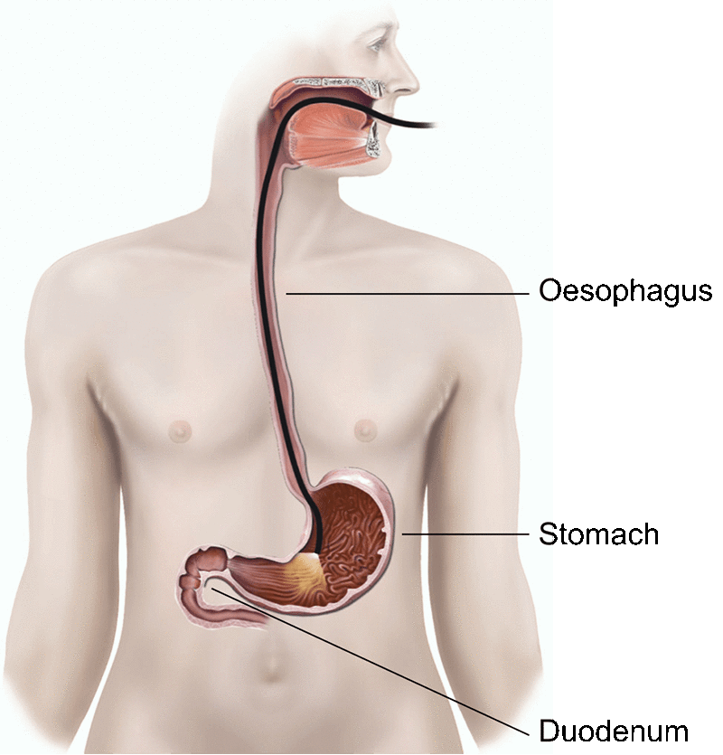 An Upper GI Endoscopy.