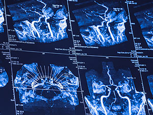 Carotid Artery Disease