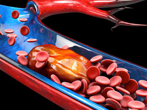 Deep Venous Thrombosis