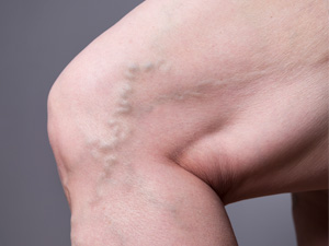 Varicose and Spider Veins