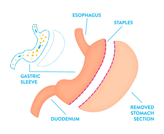 Sleeve Gastrectomy